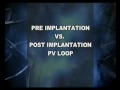 baseline vs pvloop crt.wmv