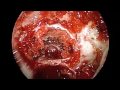 Endoscopic Removal of Pituitary Tumor Followed by Reconstruction Endoscopic Removal of Pituitary Tumor Followed by Reconstruction
