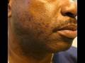 The Acne Practice  (RazorBump Bootcamp™)