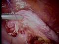 Laparoscopische Appendectomie