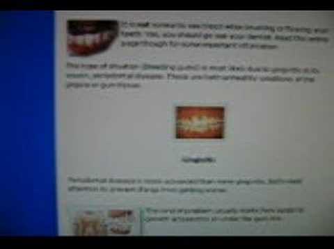 Gingivitis Get Rid of It - Part 1 Redone
