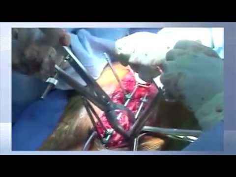 how to measure thoracic kyphosis