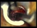 Discectomy Discectomy