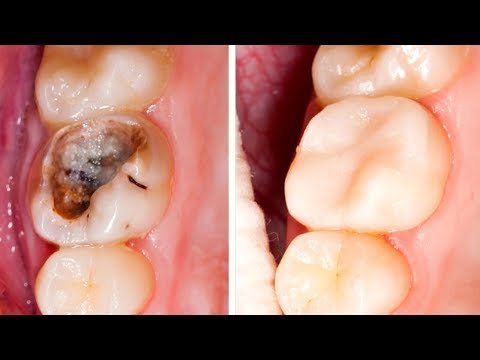 Сильный кариес на всех зубах Сильный кариес на всех зубах