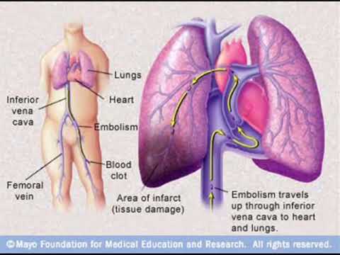 how to treat pulmonary embolism