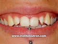 Est�tica dental: remodelado de enc�as (problema y soluci�n)