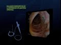 descarga Enfermedad Inflamatoria Intestinal