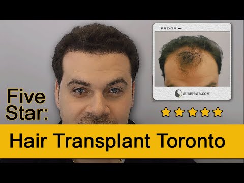 how to get a free hair transplant