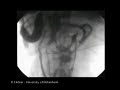 Lower GI Movies - jejumal giant contraction Lower GI Movies - jejumal giant contraction