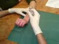 micro dermal sul polso.tecnica punch.