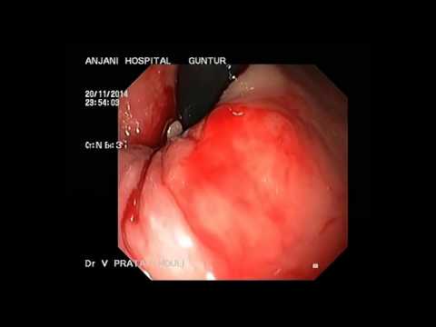 how to treat lv thrombus