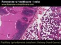 Affordable cost salivary gland surgery in India.  Salivary Gland Cancer Head and Neck Cancer