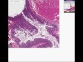 Histopathology Colon--Diverticulum Diverticulosis and Diverticulitis