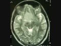 Brain tumors-MENINGIOMAS-skull base -treatment-images-dr suresh dugani/HUBLI/KARNATAK/INDIA