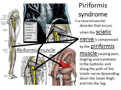 how to relieve piriformis syndrome