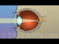 PreOp® Patient Education Lasik Laser Eye