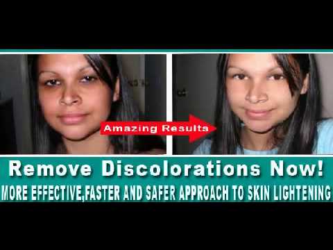 how to treat melasma