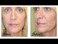 Facelift, Mini lift, Sarasota Minimal pain and bruising