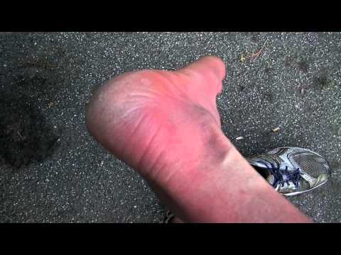 how to cure erythromelalgia