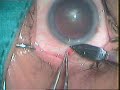 phaco under topical anesthesia