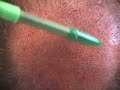 Hair transplant closeup:  crown site creation 2 dallas texas