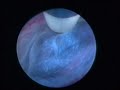endoscopic procedure in brain surgery