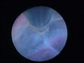 endoscopic procedure in brain surgery