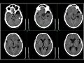 endoscopic procedure in brain surgery