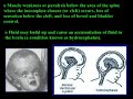 cbns-169-spina-bifida.html