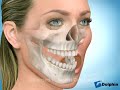 Upper Jaw Advancement Surgery