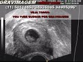 GRAVIMAGEM 64 (GESTAÇÃO INICIAL TRANS-VAGINAL) GRAVIMAGEM 64 (GESTAÇÃO INICIAL TRANS-VAGINAL)