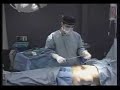 Liposuction