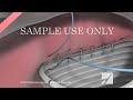 This 3D animation on abdominal aortic aneurysms depicts the anatomy of the aorta and both the open and endovascular procedure for repairing an abdominal aortic aneurysm. Abdominal aortic aneurysm (also known as AAA, pronounced 