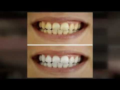 how to whiten false teeth