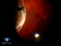Vitrectomy For Retinal Detachment VR1 Basic Techniques