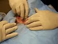 Ganglion Cyst Removal