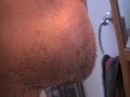 Huge zit on butt ............... chin!