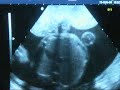 echo de la petite alice a 6 mois