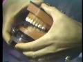 Class II Indirect Gold Inlay - Cavity Preparation