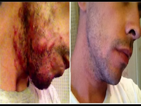 how to cure cystic pimple