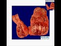 Histopathology Thyroid--Nodular goiter