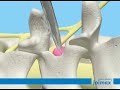 Animatie Endoscopische Hernia Operatie Animatie Endoscopische Hernia Operatie