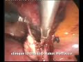 laparoscopic salpingectomy for a ruptured ectopic pregnancy laparoscopic salpingectomy for a ruptured ectopic pregnancy