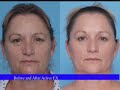 Active FX Fractional CO2 Laser Daniel C. Mills MD, FACS