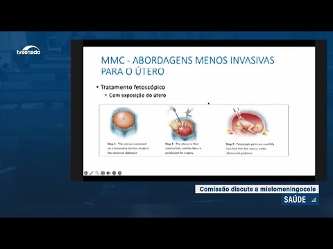 Mielomeningocele: comissão vai pedir cirurgia intrauterina no SUS