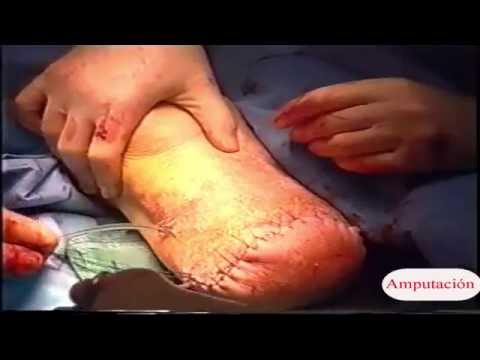 amputacion - Todos estos videos se distribuyen, para mayores de edad, con propósitos académicos, especialmente interesantes para los estudiantes de medicina.