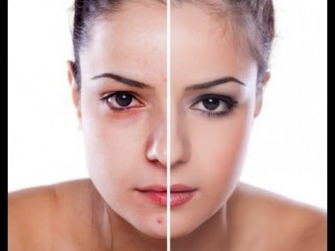 how to use witch hazel for acne