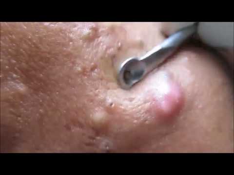 black head pore vacuum suction