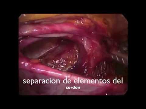 hernioplastia - paciente femenino IMC 27 con colelitiasis sintomática se realizan estudios preparatorios y se decide colecistectomia con instrumentos de 3mm la idea es reali...
