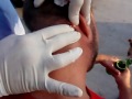 monster cyst pop on neck